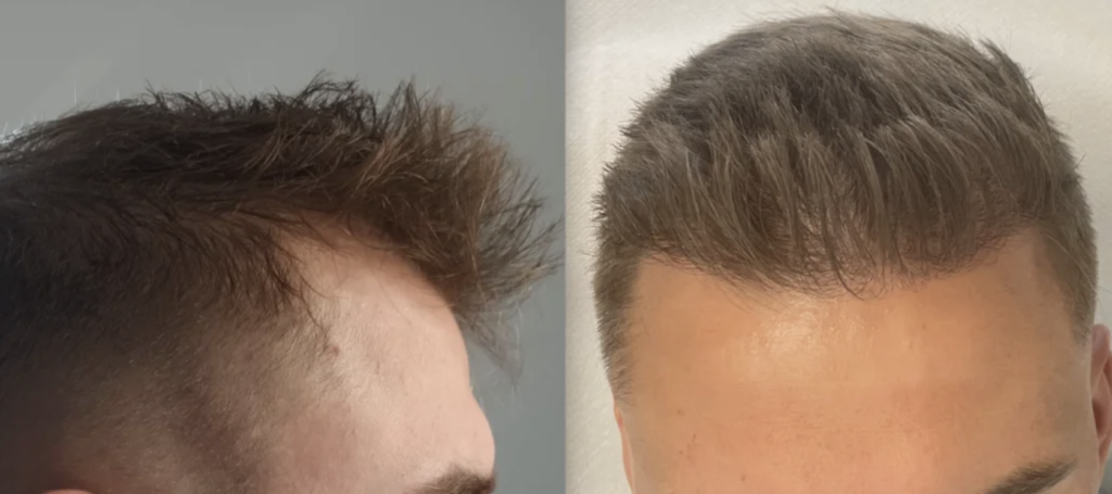Jak dosáhnout přirozené linie vlasů